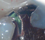 外苑前(港区北青山)の歯医者、サウラデンタルクリニック青山のマイクロスコープ精密治療