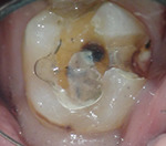 外苑前(港区北青山)の歯医者、サウラデンタルクリニック青山のマイクロスコープ精密治療