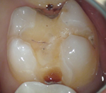 外苑前(港区北青山)の歯医者、サウラデンタルクリニック青山のマイクロスコープ精密治療
