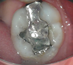 外苑前(港区北青山)の歯医者、サウラデンタルクリニック青山のマイクロスコープ精密治療