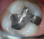 外苑前(港区北青山)の歯医者、サウラデンタルクリニック青山のマイクロスコープ精密治療