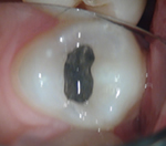 外苑前(港区北青山)の歯医者、サウラデンタルクリニック青山のマイクロスコープ精密治療