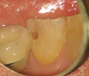 外苑前(港区北青山)の歯医者、サウラデンタルクリニック青山のマイクロスコープ精密治療