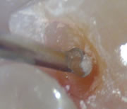 外苑前(港区北青山)の歯医者、サウラデンタルクリニック青山のマイクロスコープ精密治療