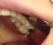 外苑前(港区北青山)の歯医者、サウラデンタルクリニック青山のマイクロスコープ精密治療