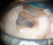 外苑前(港区北青山)の歯医者、サウラデンタルクリニック青山のマイクロスコープ精密治療