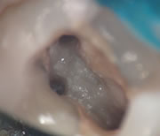 外苑前(港区北青山)の歯医者、サウラデンタルクリニック青山のマイクロスコープ精密治療