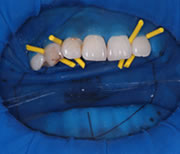 外苑前(港区北青山)の歯医者、サウラデンタルクリニック青山のマイクロスコープ精密治療