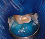 外苑前(港区北青山)の歯医者、サウラデンタルクリニック青山のマイクロスコープ精密治療