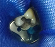 外苑前(港区北青山)の歯医者、サウラデンタルクリニック青山のマイクロスコープ精密治療